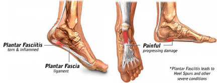 plantar-faciitis